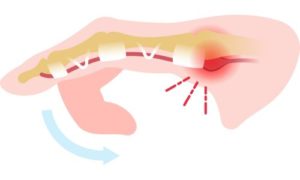 ばね指の病態説明