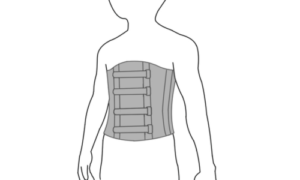 腰椎分離症の治療でコルセット固定