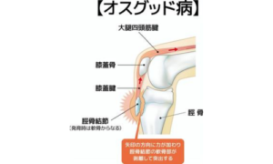 オスグッド・シュラッダー病の病態説明