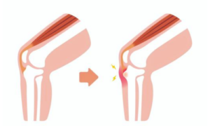 オスグッドの病態説明