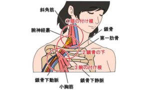 胸郭出口症候群の説明