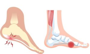 足底筋膜炎の説明