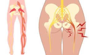 坐骨神経の説明