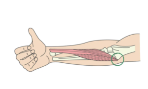 ゴルフ肘は筋肉の牽引により起こる