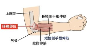外側上顆炎の説明
