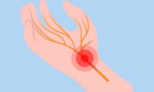 手指の痺れで悩まれている方