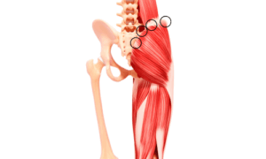 殿筋にトリガーポイントが形成されている説明
